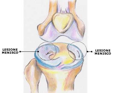 Il ginocchio - Lesioni meniscali