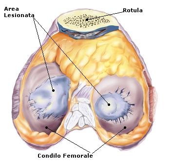 Il ginocchio - Lesioni cartilaginee