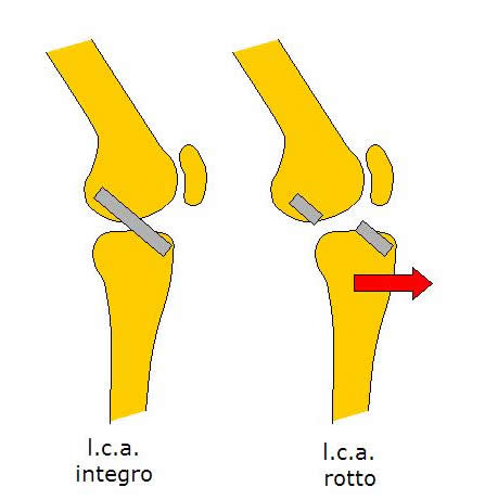 Il ginocchio - lesioni legamentose